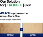 MEDIHEAL Teatree Trouble Pad used on blemish-prone skin
