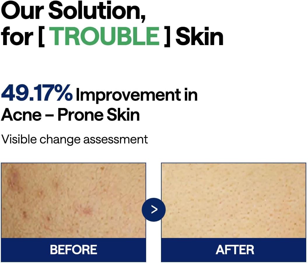 MEDIHEAL Teatree Trouble Pad used on blemish-prone skin